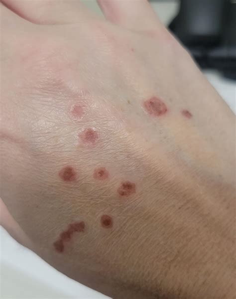 Cryosurgery for seborrheic keratoses : r/DermatologyQuestions