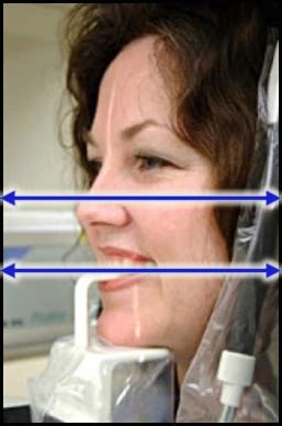 Frankfort Horizontal Occlusal Plane - Practical Panoramic Imaging ...