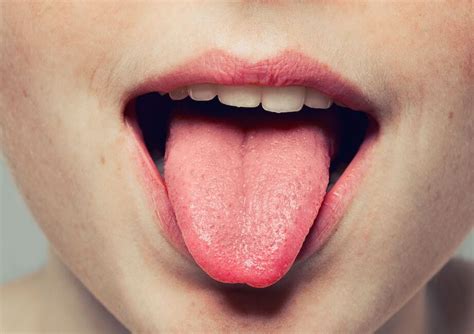 Causas y remedios de los granos en la lengua cerca de la garganta 