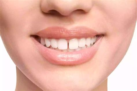 Tooth Gap: Is It Common?