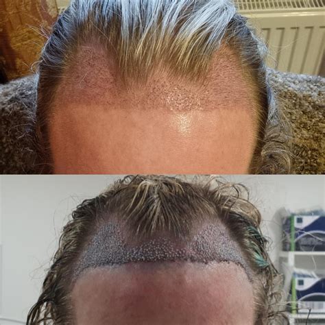Hair transplant : r/Transgender_Surgeries