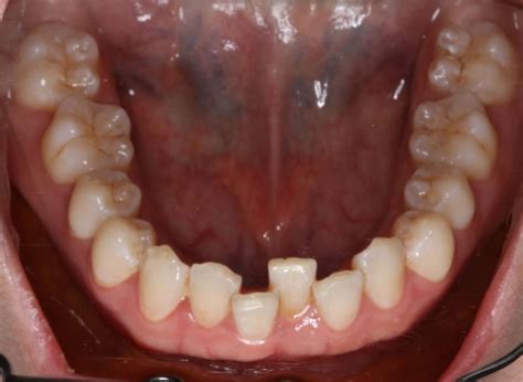 Orthodontic Relapse in Adults