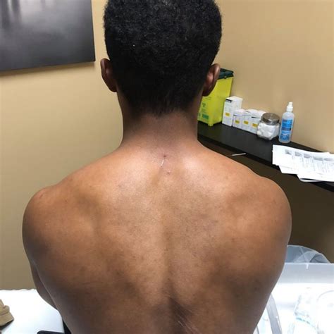 2 Day Introduction to Acupuncture and Dry Needling Course in Ottawa, ON