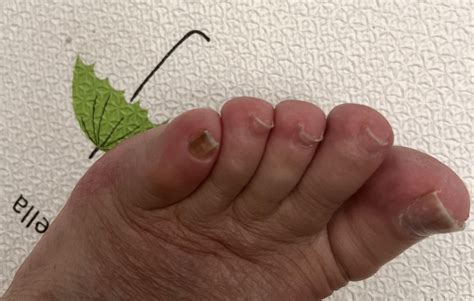 Subungual melanoma? : r/Melanoma