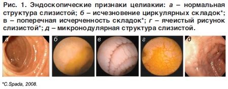 Целиакия — симптомы заболевания у детей и взрослых, причины ...