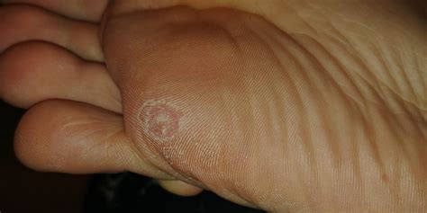 Keep going? : r/Warts