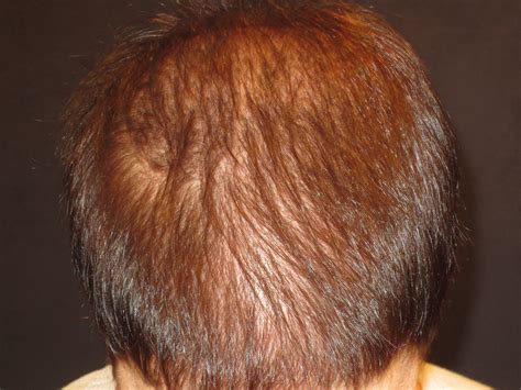 hair loss trichologist 5