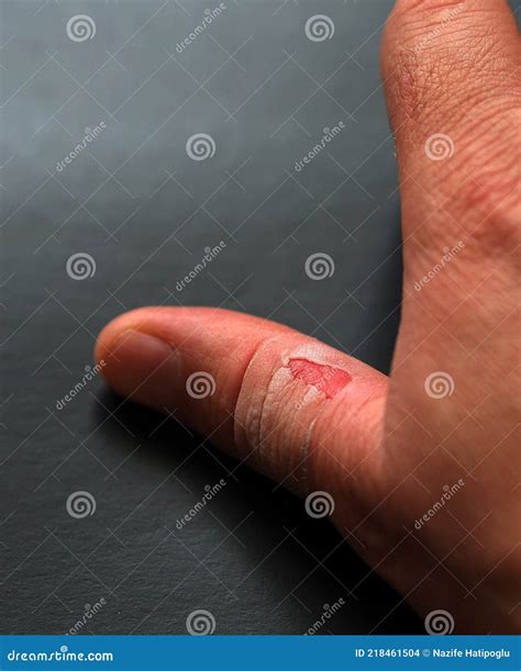 Pulling Skin From Fingers at Katie Kendall blog