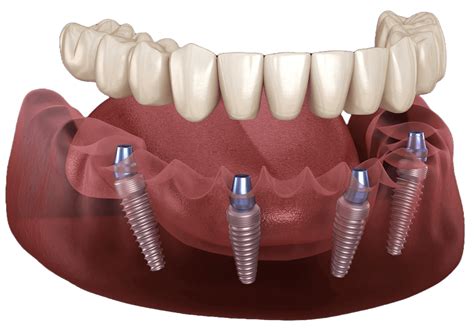 Restore Your Smile with Full Mouth Dental Implants in Texas