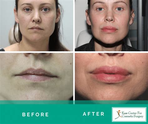 Fat Grafting Lips Before And After | Lipstutorial.org