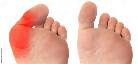 view  successful surgery  remove  severe bunion