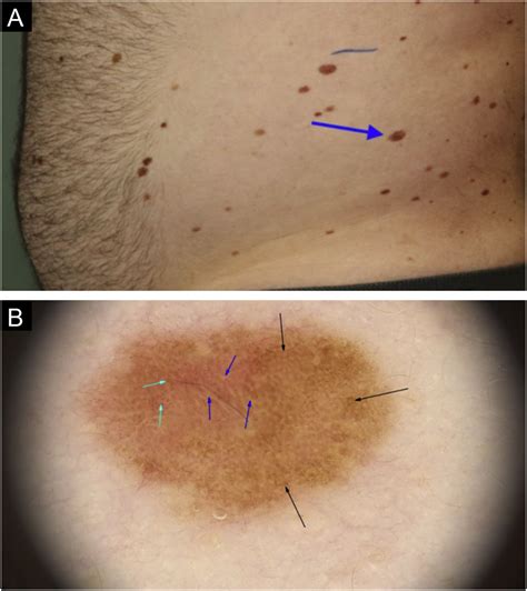 Melanomas sincrônicos e metacrônicos diagnosticados em estágios