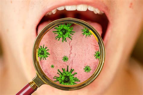 Infecções Bacterianas Na Boca - Conheça as bactérias que vivem em nossa boca e que podem nos causar ...