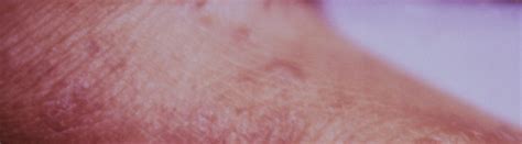 how to know if you have scabies