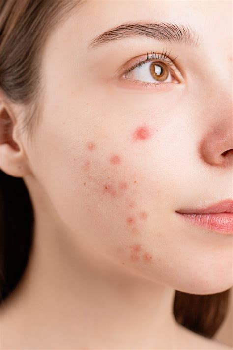 pimple redness on face