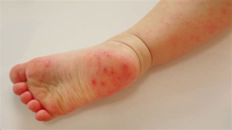 Feet With Rashes Due To Hand Foot And Mouth Disease Stock Photo ...