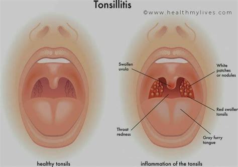 TONSILLITIS-CAUSES,SYMPTOMS,TREATMENT&PREVENTION