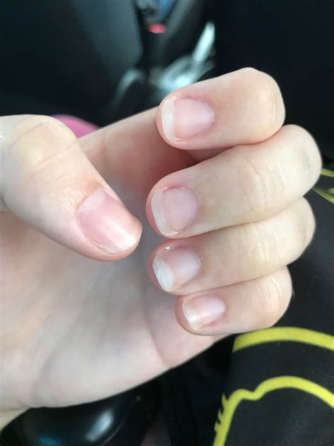 callused skin on fingertips? : r/nailbiting