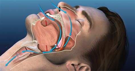 Best Anti-Snoring Devices - How They Work, Types & Benefits