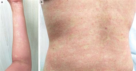 Convalescent Rash of Dengue | New England Journal of Medicine