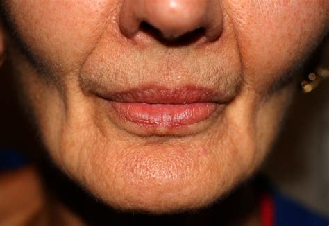 Sunken or Hollowed Cheeks | MD Laser and Cosmetics