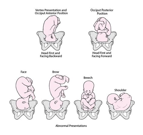 Fetal Presentation, Position, and Lie (Including Breech Presentation