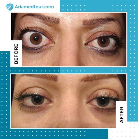 Protruding Eyes