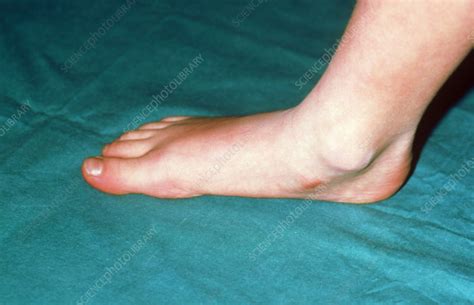 flat foot stock image  science photo library