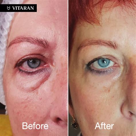 Eye Bag Treatment | HiFu Clinics UK