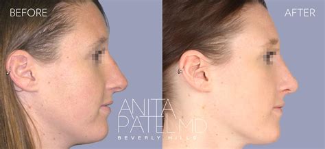 Beverly Hills Deviated Nasal Septum Repair Surgery - Septoplasty Los Angeles, California | Anita ...