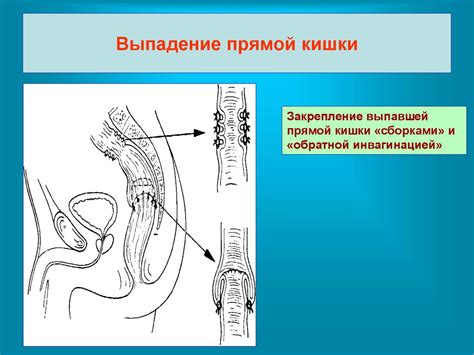 Хирургические заболевания прямой кишки - online presentation
