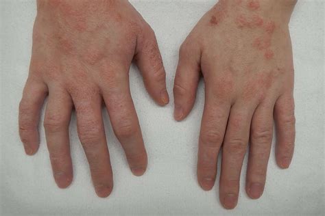 Discoid Eczema: 10 Symptoms Of Discoid Eczema