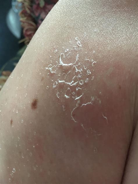 Missed a patch on my leg while applying SPF 30. Burned and peeled, of