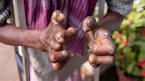 Leprosy Demystified: Expert Explains Its Symptoms, Causes, Treatment ...