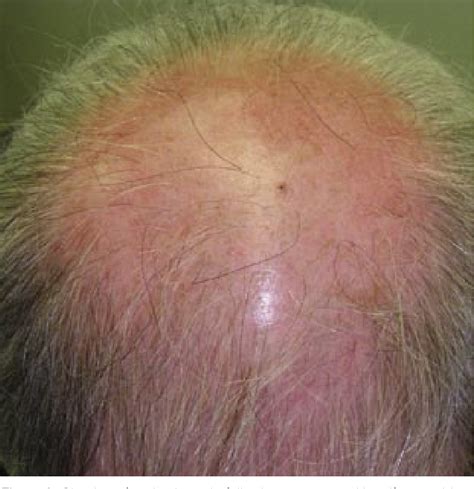 Figure 3 from Resistant scalp folliculitis secondary to Demodex ...