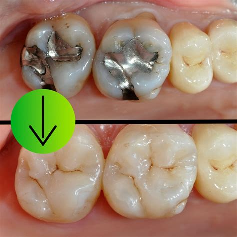 Amalgam Fillings Ireland at Christopher Schauer blog