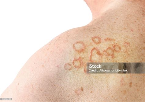 Dermatite Atopica Nas Costas - Foto de A Dermatite Atópica Nas Costas E Ombro e mais fotos de stock de ...