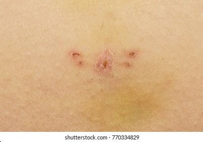 106 Hysterectomy scar Images, Stock Photos & Vectors | Shutterstock