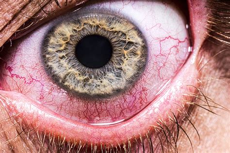 Febre E Dor Nos Olhos - Dengue: infecção pode causar sintomas nos olhos. Entenda