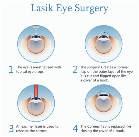 Procedure - Laser eye surgery (LASIK)