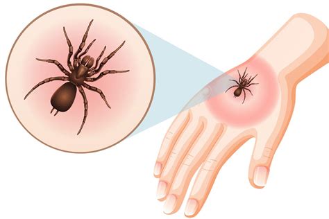 Imagens De Picada De Aranha - 9