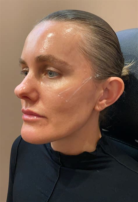 thread face lift before and after 10