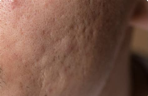 scars removal treatment service  pj true clinic