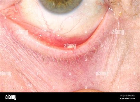 eye cyst centre    eyelid    year  man