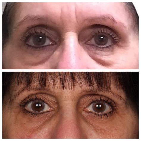 Facial Rejuvenation - Echelon Surgical Specialists