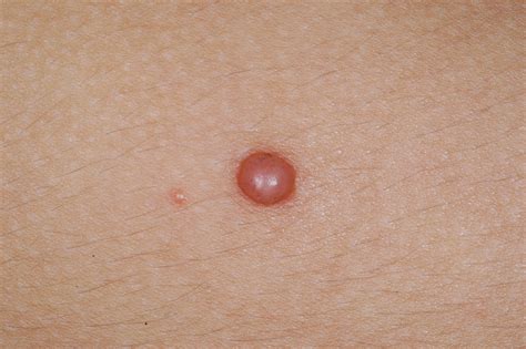 melanoma photograph - pictures, photos
