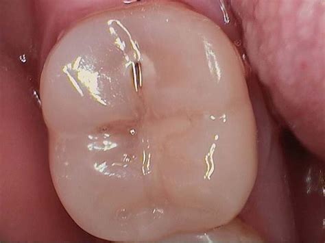 clinical case studies restoring posterior caries lesions  high