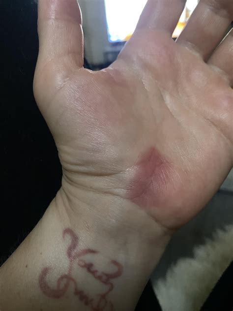 I had carpal tunnel surgery in February and wtf is this? : r/carpaltunnel