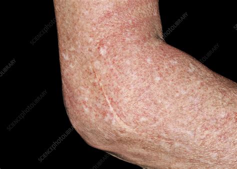 post operative elbow swelling stock image  science photo