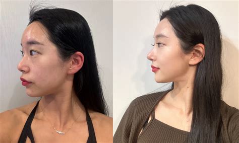 korean nose job price complete cost breakdown hidden fees